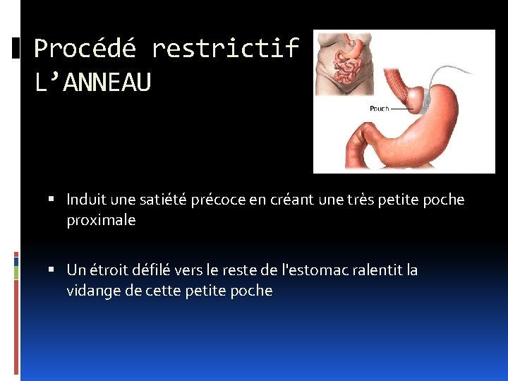 Procédé restrictif L’ANNEAU Induit une satiété précoce en créant une très petite poche proximale