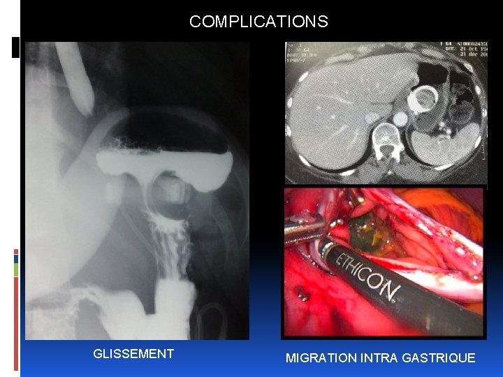 COMPLICATIONS GLISSEMENT MIGRATION INTRA GASTRIQUE 