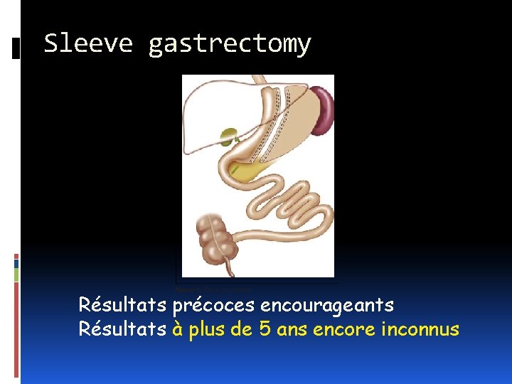 Sleeve gastrectomy Résultats précoces encourageants Résultats à plus de 5 ans encore inconnus 