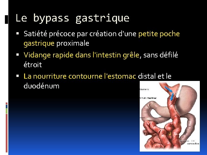 Le bypass gastrique Satiété précoce par création d'une petite poche gastrique proximale Vidange rapide