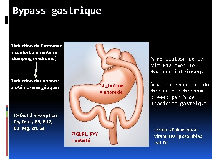 Bypass gastrique Réduction de l’estomac Inconfort alimentaire (dumping syndrome) ↘ de liaison de la