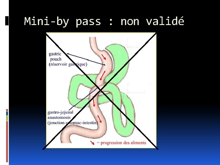 Mini-by pass : non validé 