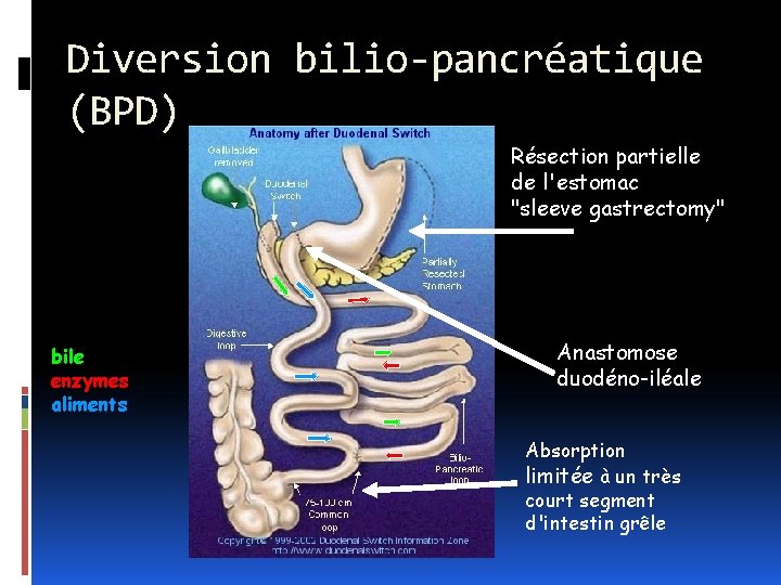 Diversion bilio-pancréatique (BPD) Résection partielle de l'estomac "sleeve gastrectomy" bile enzymes aliments Anastomose duodéno-iléale