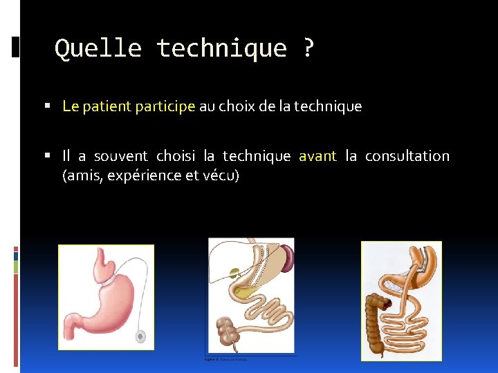 Quelle technique ? Le patient participe au choix de la technique Il a souvent