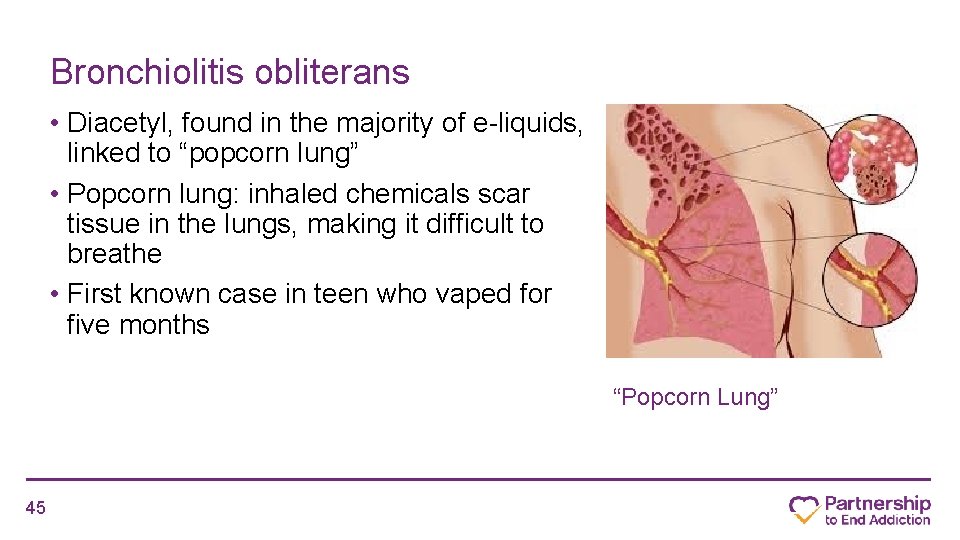 Bronchiolitis obliterans • Diacetyl, found in the majority of e-liquids, linked to “popcorn lung”