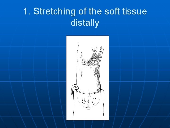 1. Stretching of the soft tissue distally 