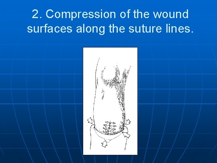 2. Compression of the wound surfaces along the suture lines. 