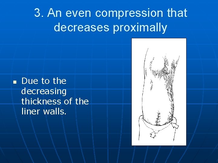 3. An even compression that decreases proximally n Due to the decreasing thickness of