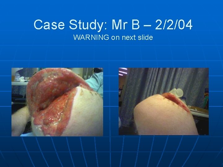 Case Study: Mr B – 2/2/04 WARNING on next slide 