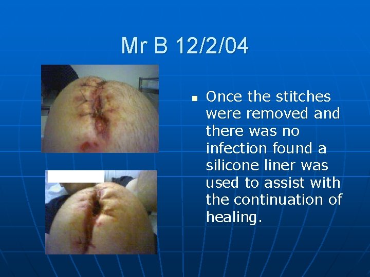 Mr B 12/2/04 n Once the stitches were removed and there was no infection