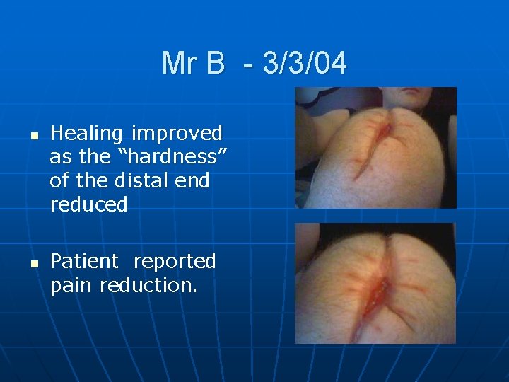 Mr B - 3/3/04 n n Healing improved as the “hardness” of the distal