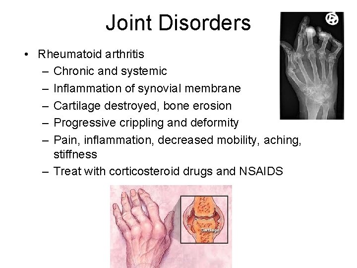 Joint Disorders • Rheumatoid arthritis – Chronic and systemic – Inflammation of synovial membrane