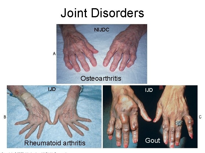 Joint Disorders NIJDC Osteoarthritis IJD Rheumatoid arthritis IJD Gout 