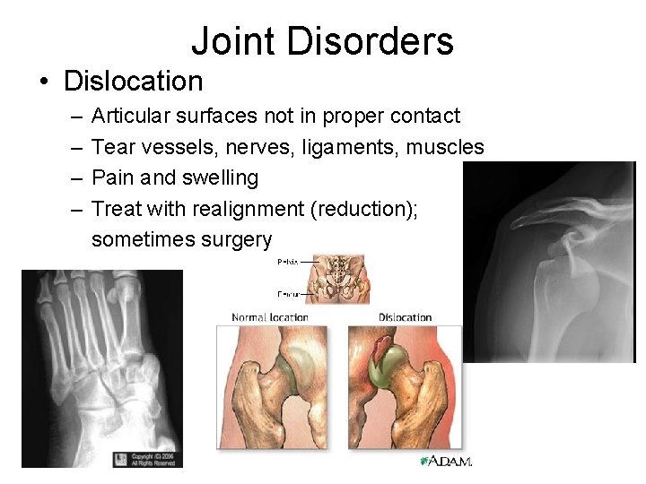 Joint Disorders • Dislocation – – Articular surfaces not in proper contact Tear vessels,