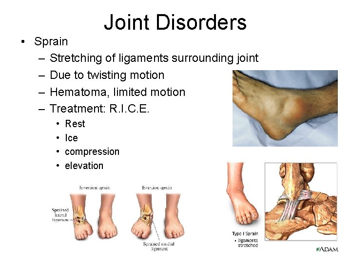 Joint Disorders • Sprain – Stretching of ligaments surrounding joint – Due to twisting