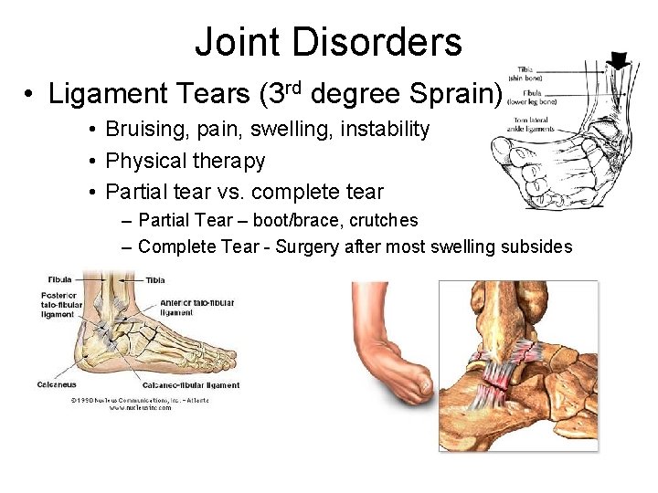 Joint Disorders • Ligament Tears (3 rd degree Sprain) • Bruising, pain, swelling, instability