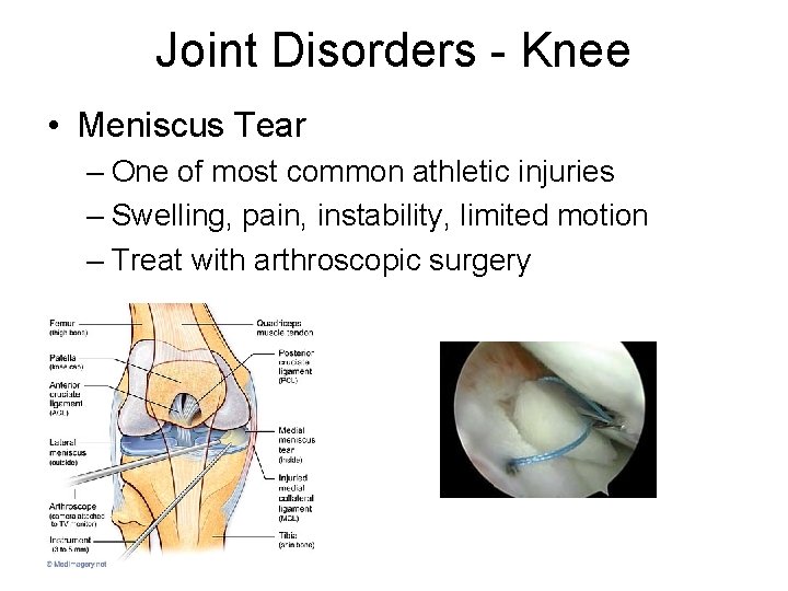 Joint Disorders - Knee • Meniscus Tear – One of most common athletic injuries