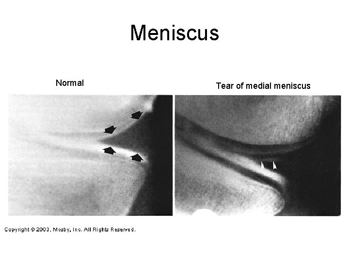 Meniscus Normal Tear of medial meniscus 