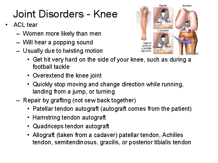 Joint Disorders - Knee • ACL tear – Women more likely than men –