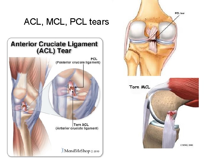 ACL, MCL, PCL tears 