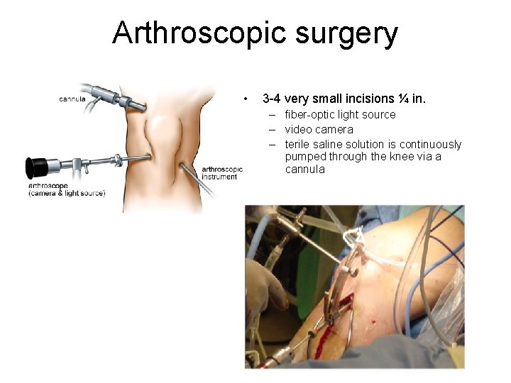 Arthroscopic surgery • 3 -4 very small incisions ¼ in. – fiber-optic light source