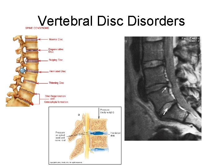 Vertebral Disc Disorders 