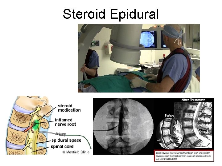 Steroid Epidural 