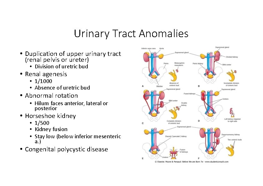 Urinary Tract Anomalies • Duplication of upper urinary tract (renal pelvis or ureter) •