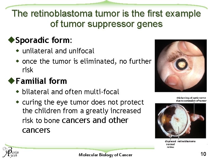 The retinoblastoma tumor is the first example of tumor suppressor genes u. Sporadic form: