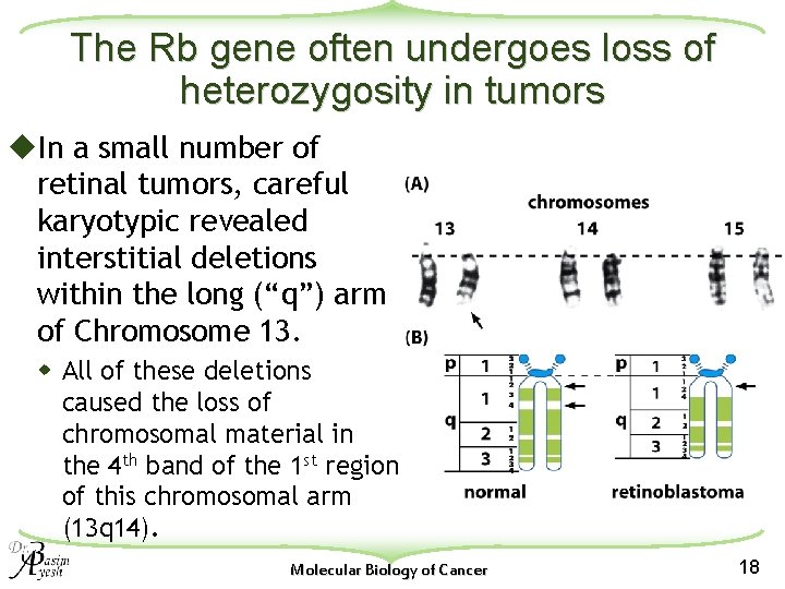 The Rb gene often undergoes loss of heterozygosity in tumors u. In a small