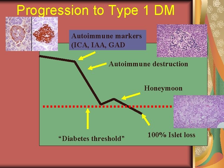 Progression to Type 1 DM Autoimmune markers (ICA, IAA, GAD Autoimmune destruction Honeymoon “Diabetes