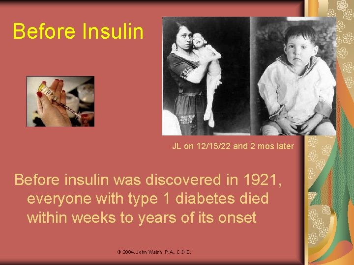 Before Insulin JL on 12/15/22 and 2 mos later Before insulin was discovered in