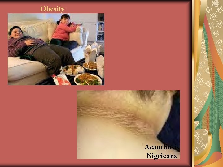 Obesity Acanthosis Nigricans 