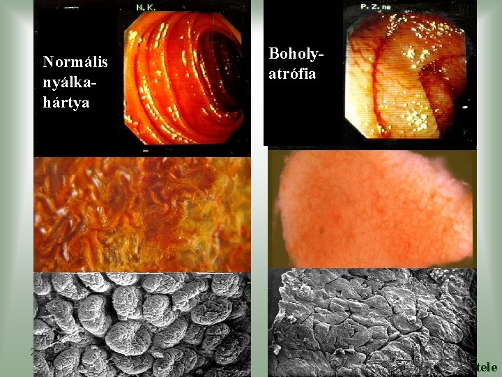 Normális nyálkahártya Boholyatrófia 2011. jún. 2. Dr. Korponay-Szabó Ilma felvétele 