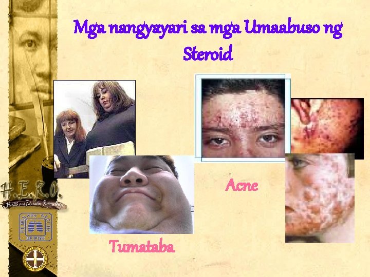 Mga nangyayari sa mga Umaabuso ng Steroid Acne Tumataba 