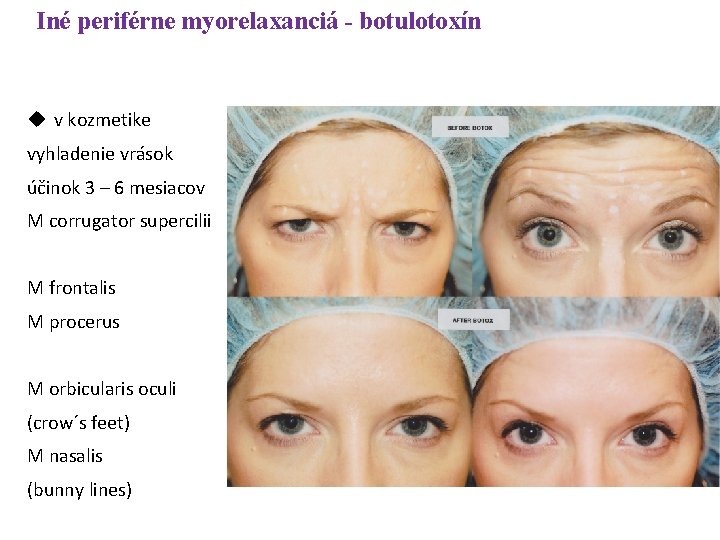 Iné periférne myorelaxanciá - botulotoxín v kozmetike vyhladenie vrások účinok 3 – 6 mesiacov