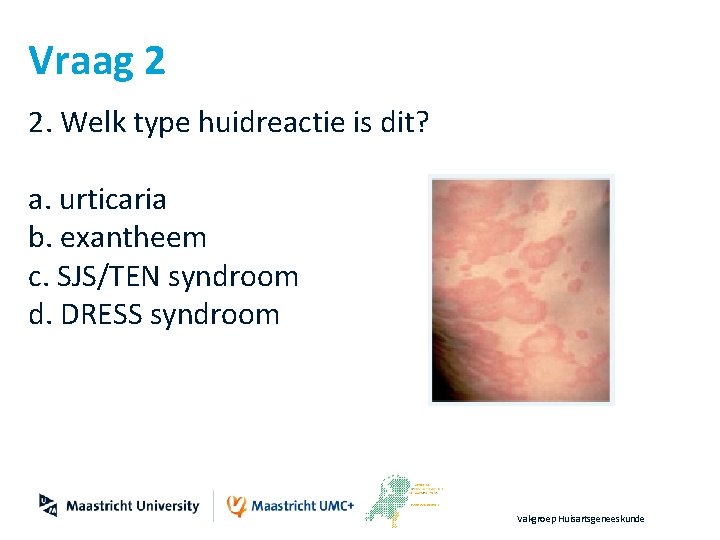 Vraag 2 2. Welk type huidreactie is dit? a. urticaria b. exantheem c. SJS/TEN