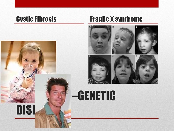 Cystic Fibrosis Fragile X syndrome STEM CELLS –GENETIC DISEASE 