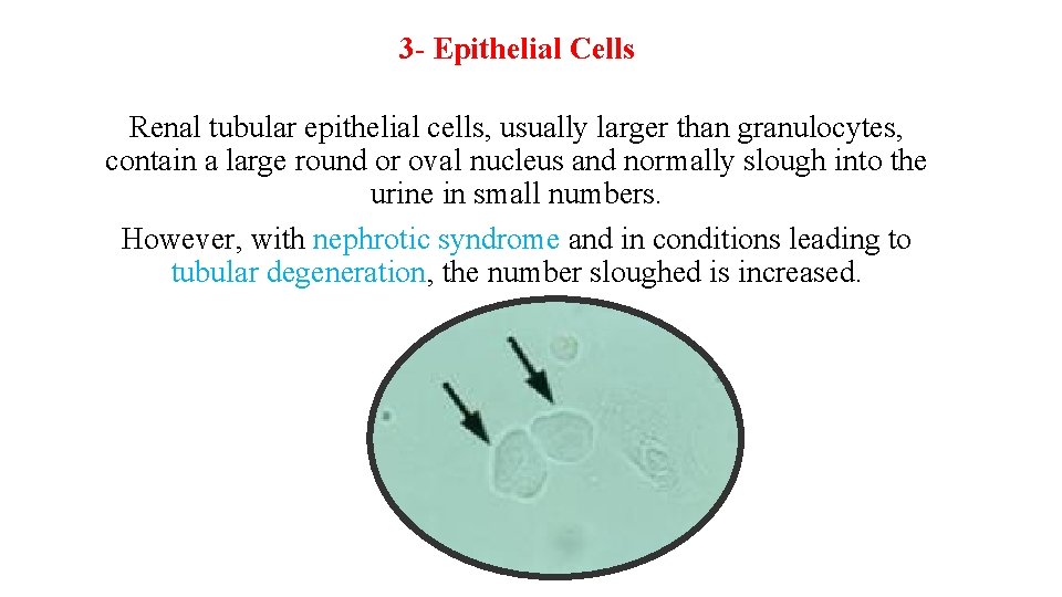 3 - Epithelial Cells Renal tubular epithelial cells, usually larger than granulocytes, contain a