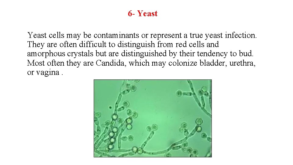 6 - Yeast cells may be contaminants or represent a true yeast infection. They