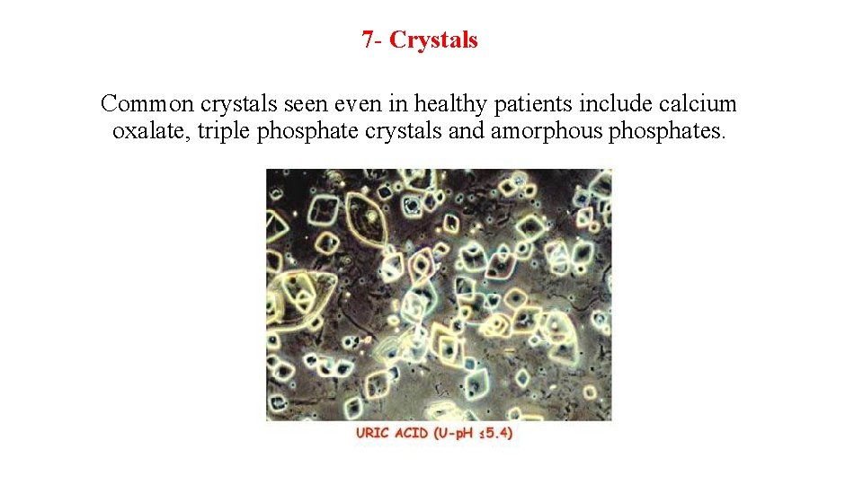 7 - Crystals Common crystals seen even in healthy patients include calcium oxalate, triple