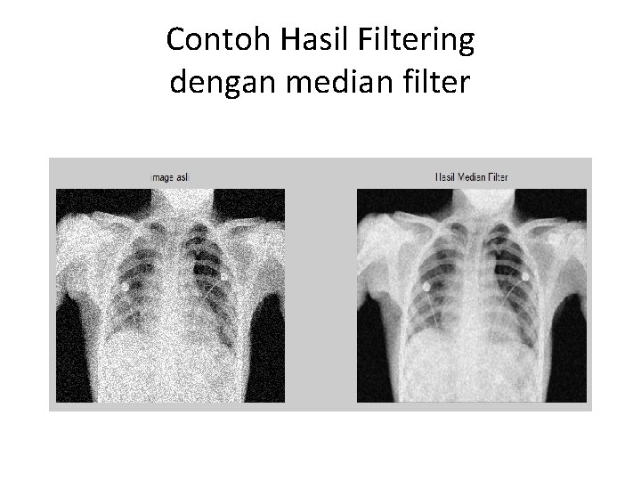 Contoh Hasil Filtering dengan median filter 