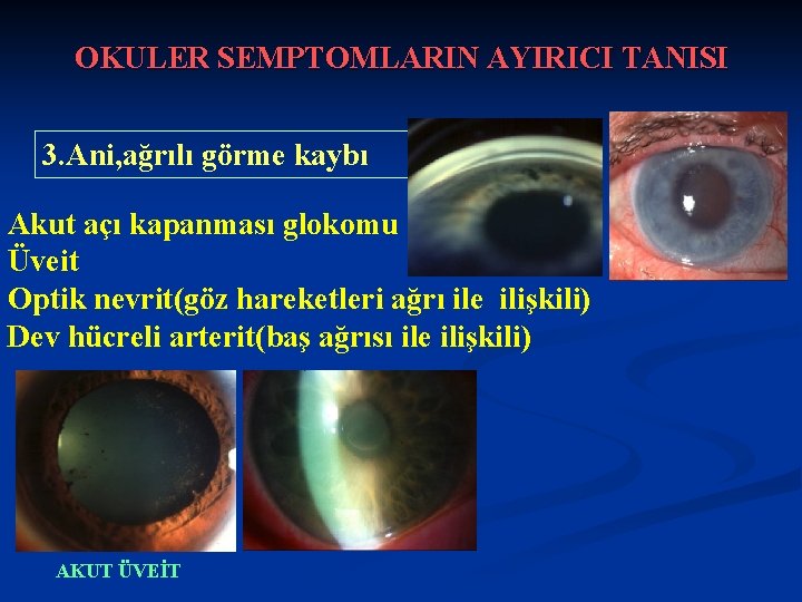 OKULER SEMPTOMLARIN AYIRICI TANISI 3. Ani, ağrılı görme kaybı Akut açı kapanması glokomu Üveit