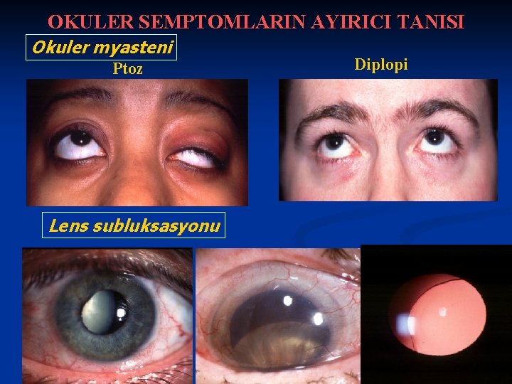 OKULER SEMPTOMLARIN AYIRICI TANISI Okuler myasteni Ptoz Lens subluksasyonu Diplopi 