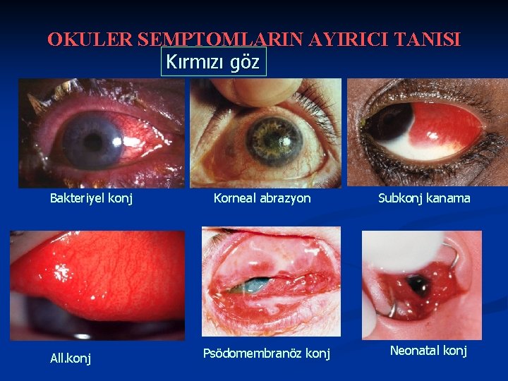 OKULER SEMPTOMLARIN AYIRICI TANISI Kırmızı göz Bakteriyel konj All. konj Korneal abrazyon Psödomembranöz konj