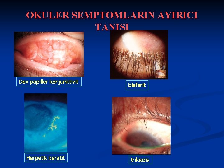 OKULER SEMPTOMLARIN AYIRICI TANISI Dev papiller konjunktivit Herpetik keratit blefarit trikiazis 