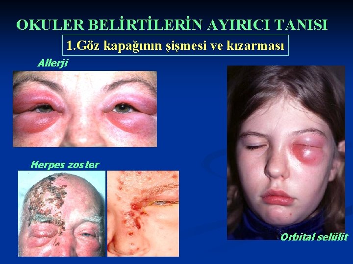 OKULER BELİRTİLERİN AYIRICI TANISI 1. Göz kapağının şişmesi ve kızarması Allerji Herpes zoster Orbital