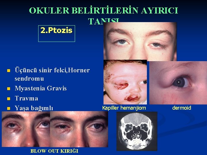 OKULER BELİRTİLERİN AYIRICI TANISI 2. Ptozis n n n Üçüncü sinir felci, Horner sendromu