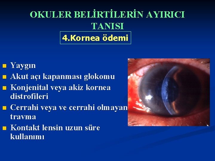 OKULER BELİRTİLERİN AYIRICI TANISI 4. Kornea ödemi n n n Yaygın Akut açı kapanması