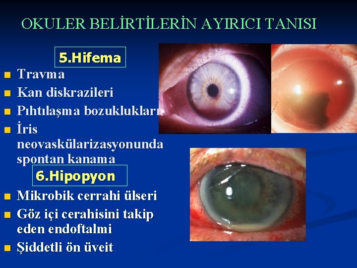 OKULER BELİRTİLERİN AYIRICI TANISI n n n n 5. Hifema Travma Kan diskrazileri Pıhtılaşma